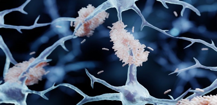Chinês de 19 com Mal de Alzheimer