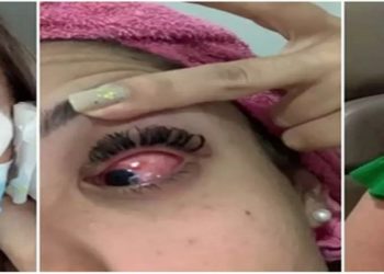 uso de pomadas, mulheres ficam cegas