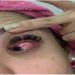uso de pomadas, mulheres ficam cegas