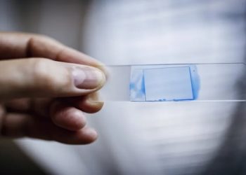 brasileiros infectados por superfungo candida auris