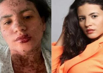 Síndrome de Stevens-Johnson: conheça a doença que afetou mulher de Frank Aguiar