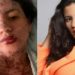 Síndrome de Stevens-Johnson: conheça a doença que afetou mulher de Frank Aguiar