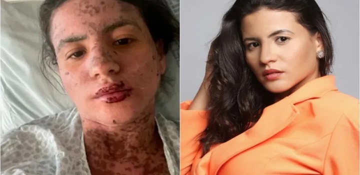 Síndrome de Stevens-Johnson: conheça a doença que afetou mulher de Frank Aguiar