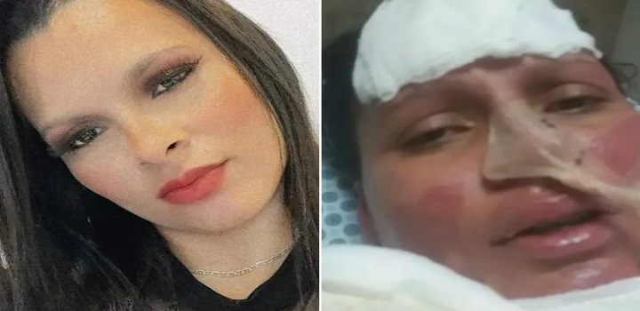 mulher queimada pelo marido em franca sp