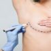 avanços da mamoplastia