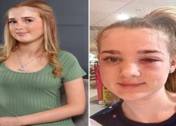 Menina de 13 anos quase fica cega por dica de beleza que viu no TikTok