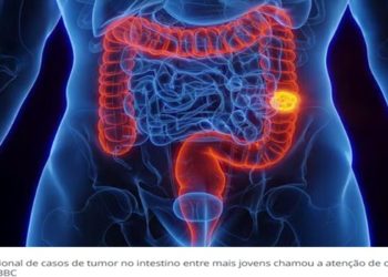 O 'assustador' crescimento do câncer colorretal em pessoas de até 50 anos