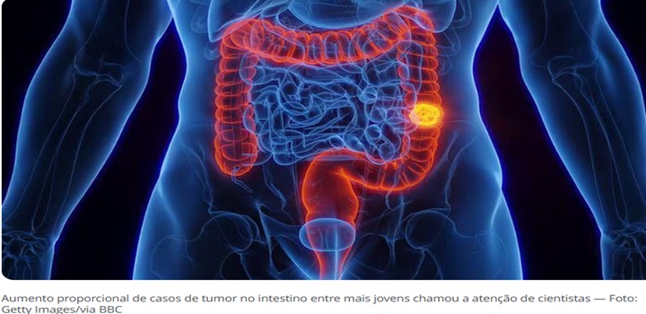 O 'assustador' crescimento do câncer colorretal em pessoas de até 50 anos