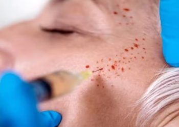 Vampire Facial: três mulheres foram infectadas com HIV após procedimento estético em clínica clandestina, nos EUA