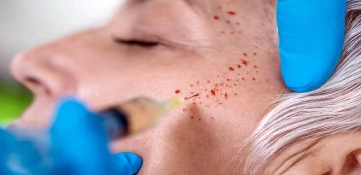 Vampire Facial: três mulheres foram infectadas com HIV após procedimento estético em clínica clandestina, nos EUA