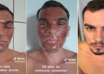 peeling de fenol a venda na internet