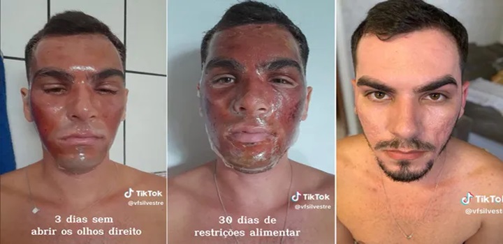 peeling de fenol a venda na internet