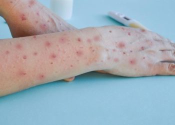 MPOX NO MUNDO, VARIOLA DOS MACACOS