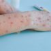 MPOX NO MUNDO, VARIOLA DOS MACACOS