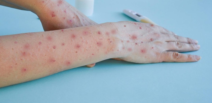 MPOX NO MUNDO, VARIOLA DOS MACACOS