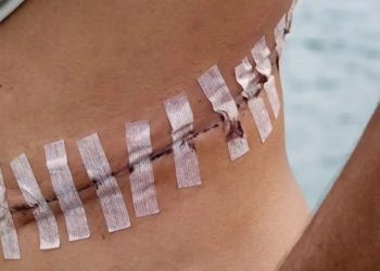 Entidades falam em epidemia de tráfico de órgãos na África