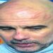 guardiola machucado