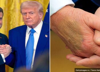 manchas na mão de donald trump