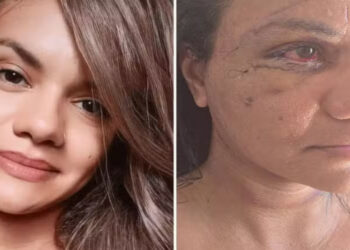 Juliana Garcia, espancada com 61 socos em elevador, mostra rosto uma semana após cirurgia facial. Agressor está preso por tentativa de feminicídio.
