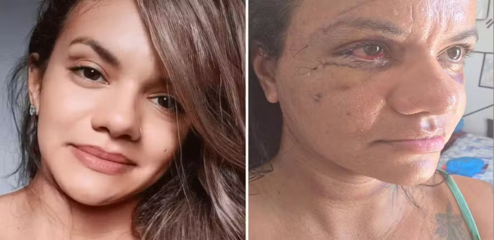 Juliana Garcia, espancada com 61 socos em elevador, mostra rosto uma semana após cirurgia facial. Agressor está preso por tentativa de feminicídio.