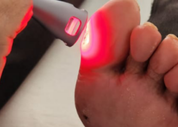 Estudo com luz de LED apresenta resultados positivos no tratamento de feridas em pés diabéticos, reduzindo o risco de amputações e oferecendo alternativa acessível para pacientes do SUS.