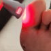 Estudo com luz de LED apresenta resultados positivos no tratamento de feridas em pés diabéticos, reduzindo o risco de amputações e oferecendo alternativa acessível para pacientes do SUS.