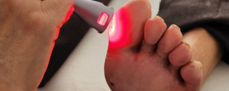 Estudo com luz de LED apresenta resultados positivos no tratamento de feridas em pés diabéticos, reduzindo o risco de amputações e oferecendo alternativa acessível para pacientes do SUS.