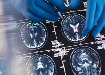 Pesquisa com milhares de mulheres aponta que a menopausa está ligada a alterações no cérebro semelhantes às do Alzheimer.