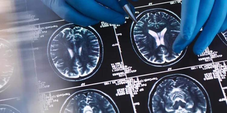Pesquisa com milhares de mulheres aponta que a menopausa está ligada a alterações no cérebro semelhantes às do Alzheimer.