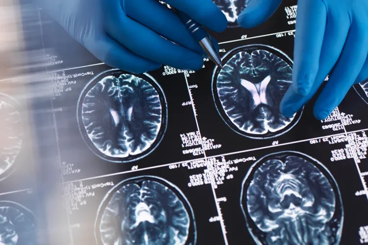 Pesquisa com milhares de mulheres aponta que a menopausa está ligada a alterações no cérebro semelhantes às do Alzheimer.