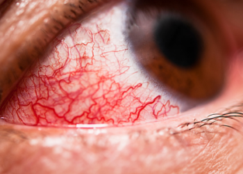 Conjuntivite: como identificar, tratar e prevenir a doença ocular