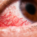 Conjuntivite: como identificar, tratar e prevenir a doença ocular