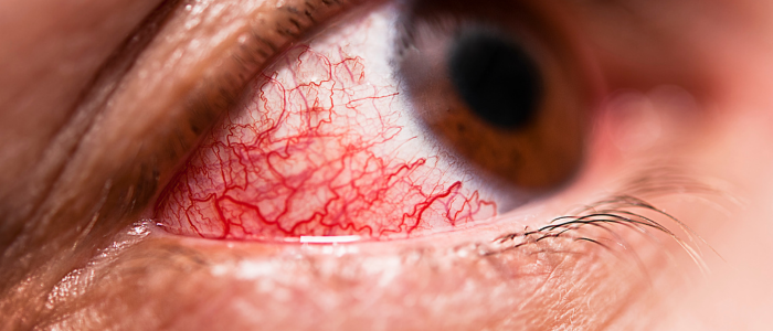 Conjuntivite: como identificar, tratar e prevenir a doença ocular