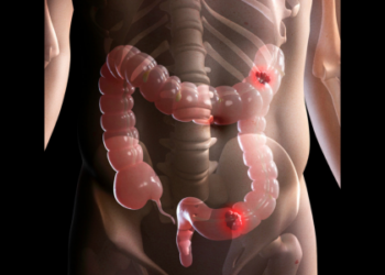 Estudo da Universidade de Genebra aponta que novo exame de fezes com inteligência artificial identifica 90% dos casos de câncer de intestino.