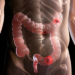 Estudo da Universidade de Genebra aponta que novo exame de fezes com inteligência artificial identifica 90% dos casos de câncer de intestino.