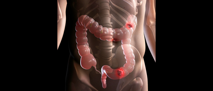 Estudo da Universidade de Genebra aponta que novo exame de fezes com inteligência artificial identifica 90% dos casos de câncer de intestino.