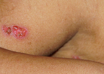 Brasil mantém monitoramento da Mpox após novos registros da doença. Especialistas destacam importância da vigilância e prevenção.
