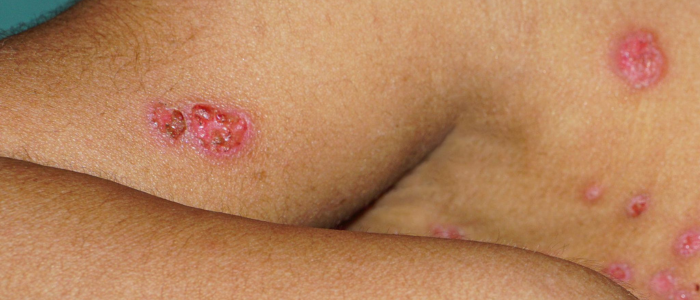 Brasil mantém monitoramento da Mpox após novos registros da doença. Especialistas destacam importância da vigilância e prevenção.