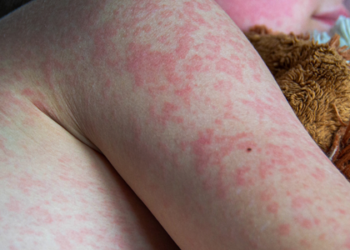 Casos de sarampo explodem nas Américas e Opas emite alerta sanitário