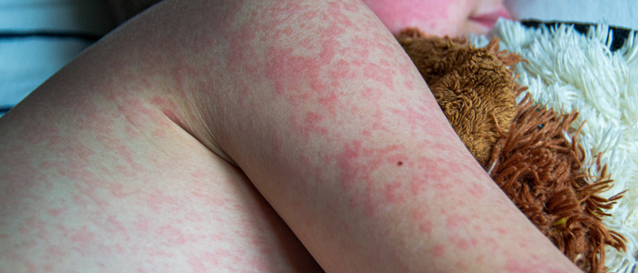 Casos de sarampo explodem nas Américas e Opas emite alerta sanitário
