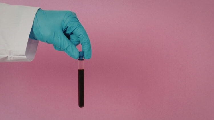 Cientistas desenvolvem exame de sangue que pode identificar tumor cerebral com mais de 90% de precisão.