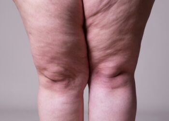 Saiba diferenciar lipedema e linfedema e entender sintomas e tratamentos