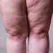 Saiba diferenciar lipedema e linfedema e entender sintomas e tratamentos
