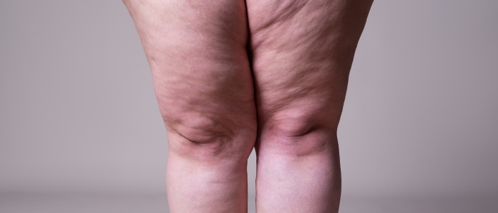 Saiba diferenciar lipedema e linfedema e entender sintomas e tratamentos