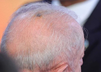 Lula inicia radioterapia preventiva após retirada de câncer de pele
