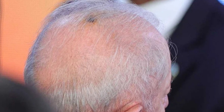 Lula inicia radioterapia preventiva após retirada de câncer de pele