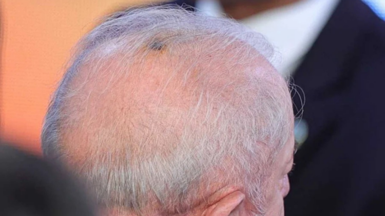 Lula inicia radioterapia preventiva após retirada de câncer de pele