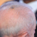 Lula inicia radioterapia preventiva após retirada de câncer de pele