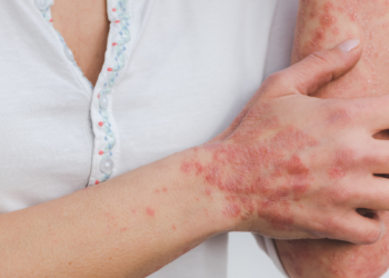Anvisa autoriza novo medicamento biossimilar indicado para psoríase, artrite psoriásica, doença de Crohn e colite ulcerativa.