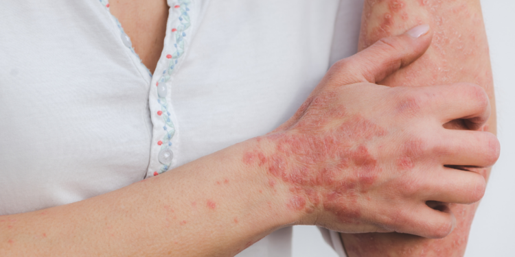 Anvisa autoriza novo medicamento biossimilar indicado para psoríase, artrite psoriásica, doença de Crohn e colite ulcerativa.